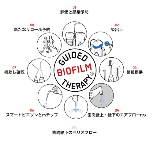 Guided Biofilm Therapy(GBT)